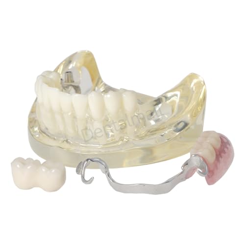 Dental Typodont Restoration Model with 2 Implants Partial Denture Demo M6022
