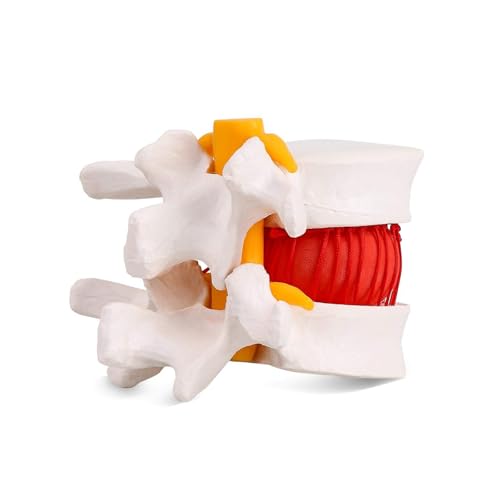 Modèle de disque hernié lombaire AMITD pour expliquer la compression nerveuse - 2