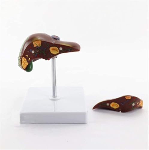 Human liver pathological stones anatomical model, medical model, educational model anatomical model, suitable for medical school education learning teaching aids demonstration laboratory scientific eq