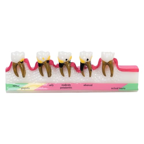 Sarini Modelo Periodontal Dental de 1 Pieza, Modelo de Desarrollo de Caries, Modelo de Periodontitis para Demostración de Enseñanza de Clasificación Periodontal de Modelos Dentales