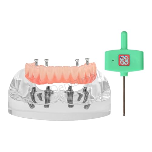 Dentalmall Dental Restoration Implant Teeth Model for Lower Jaw with 4 Screws M-6027