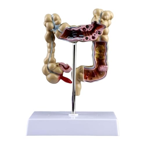 Modelo de lesión colorrectal humana, anatomía patológica, enfermedades del colon, intestino, herramienta de aprendizaje de enseñanza médica