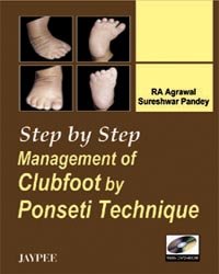 Paperback Step By Step Management Of Clubfoot By Ponseti Technique Book
