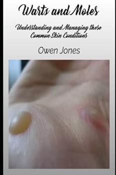 Paperback Warts and Moles: Understanding and Managing these Common Skin Conditions Book
