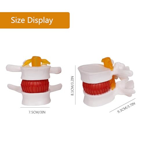 Modèle de disque hernié lombaire AMITD pour expliquer la compression nerveuse - 7
