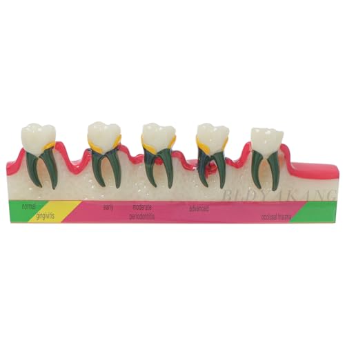 Dental Typodont Periodontal Disease Dental Caries Developing Model Dental Teeth Model for Dental Tooth Anatomy Study Doctor-Patient and Oral Care Education (M4029 Periodontal Disease Teeth Model)