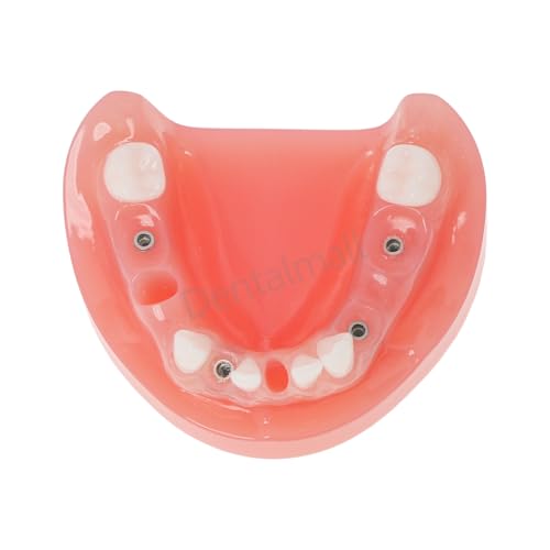Dental Implant Typodont Restoration Teeth Model Lower Jaw M6019