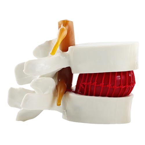 Modèle d'hernie discale lombaire 3D AMITD de haute précision - 2