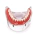 Dentalmall Dental Implant Teeth Demo Model Overdenture Restoration with 4 Implants Model M6003