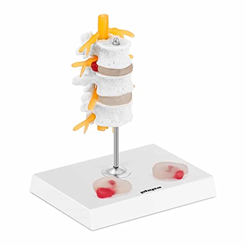 physa PHY-SM-6 Bandscheibe Modell Bandscheibenvorfall Lendenwirbel koloriert