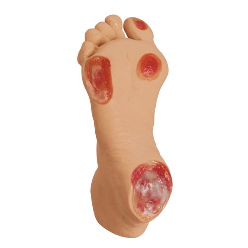Nasco Elderly Pressure Ulcer Foot