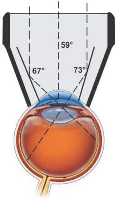 Goniolens miroir OPTICLEAR pour visualiser l'angle irido-cornéen sans reflet