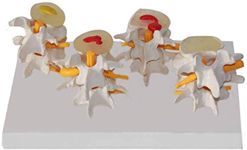 Anatomy Model, Lumbar Model - Human Lumbar Lesion Spine Statue Display Model - Life Size Spine Model - Human Anatomy Science Models - for Medical Educational Training Aid Tool for Medical Demonstratio