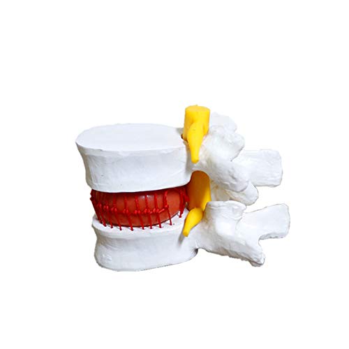 Miniatura 6 de Anatómica Hernia Lumbar Vértebras Disco Prolapso Modelo Anatomía Humana Modelo Blanco
