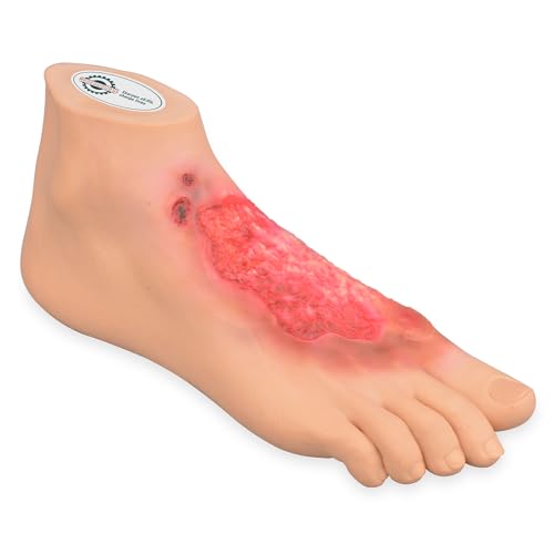 Modèle de pied brûlant chimiquement avec simulation de lésions tissulaires réalistes