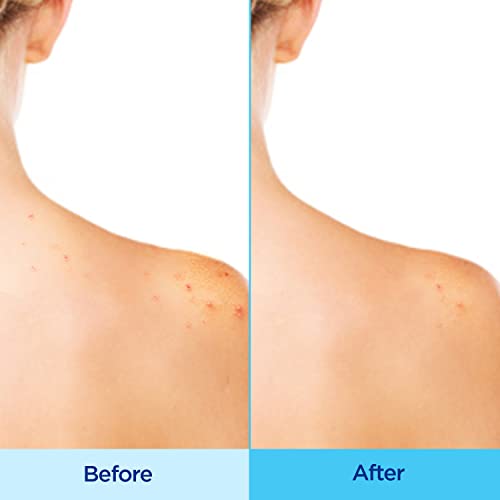 Differin Acne Body Spray, Acne Treatment With Salicylic Acid By The Makers Of Differin Gel, 360 Formula For Back Acne, Chest And Shoulders, 6 Oz #TOP5