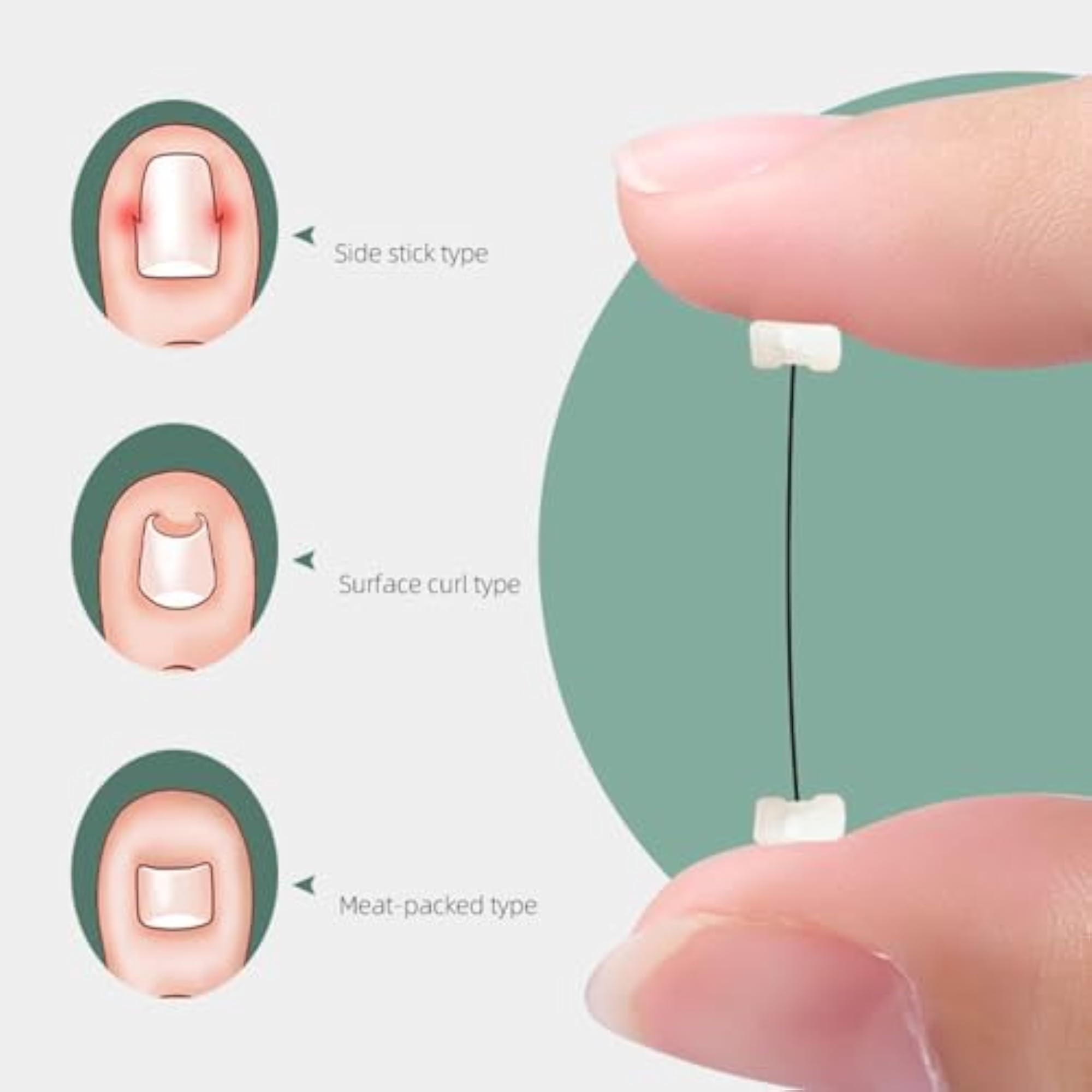 Professional Ingrown Toenail Correction Kit for Women and Men