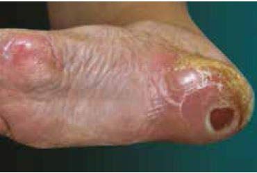 Euroderm Foam Heel (cm 12 x cm 13)- Schiuma di