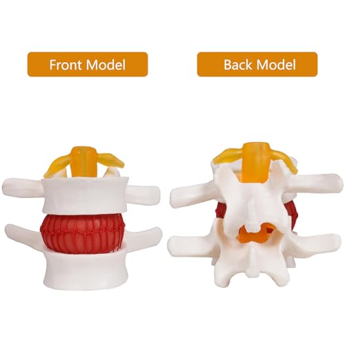 Modèle de disque hernié lombaire AMITD pour expliquer la compression nerveuse - 5