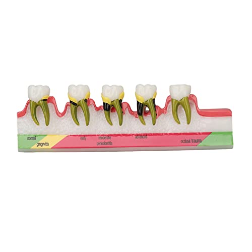 Modelo De Enfermedad Periodontal Dental, Modelo De Enfermedad Periodontal De Dientes, Diferentes Etapas, Modelo De Exhibición De Periodontitis Dental De Resina
