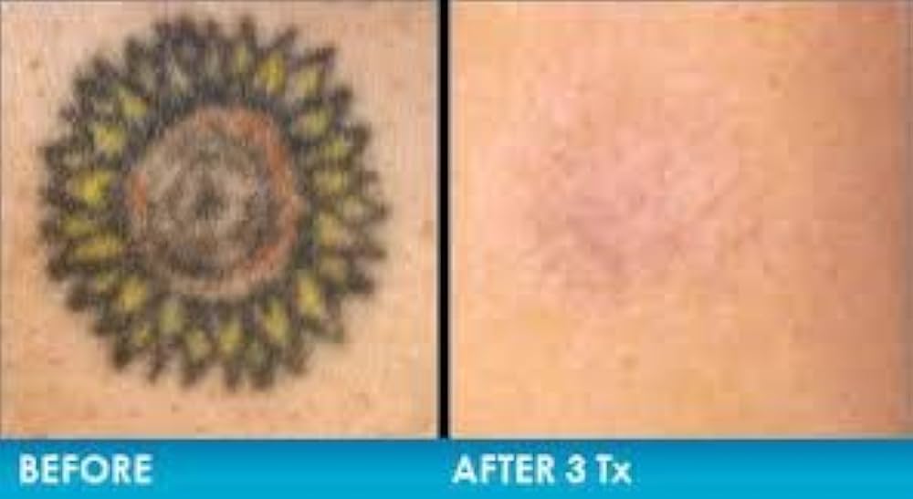 Top 54 Tattoo Removal Cream In India Latest In cdgdbentre