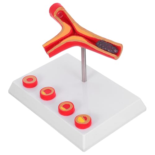 Modèle médical cardiovasculaire pour visualiser l'athérosclérose et la thrombose