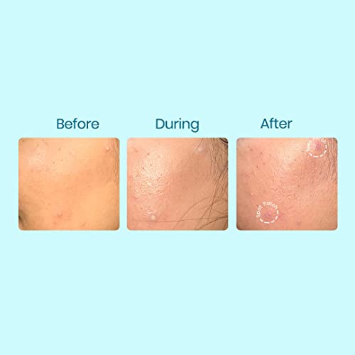 Image of SPOT PATCH BHA Ultra Slim (102 Dots | 2 Sizes) | Acne Pimple Patches Hydrocolloid for Blemish | Made in Korea | Sterilized