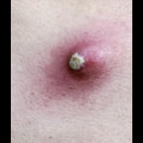 Play Leaking Cyst by Pilonidal Cystectomy on Amazon Music