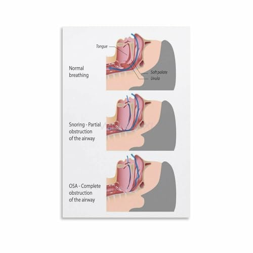 Sleep Apnea Symptoms Knowledge Guide Poster Hospital Science (4) Canvas
