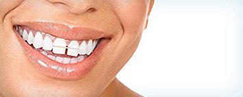 Miniatura 4 de IVORIE Bandas dentales transparentes de ortodoncia para dientes, 80 unidades (18 pulgadas pesadas)