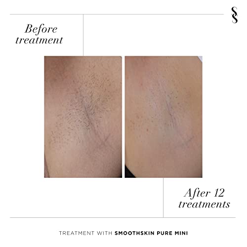 Smoothskin Pure Mini Intelligent Ultrafast Ipl Permanent Hair Reduction For Women & Men - Body & Face – Fda Cleared #TOP5