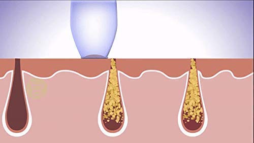 Image of BINSBARRY4 in 1 Multi-Function Blackhead Whitehead Extractor Remover Device - Acne Pimple Pore Cleaner Vacuum Suction Tool for Men and Women (White)