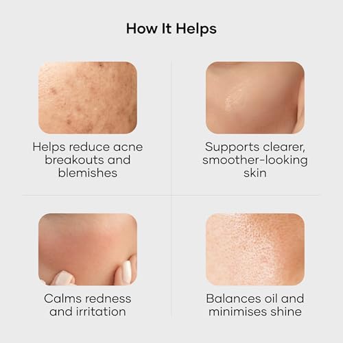 Image of Cureskin Acne Control Gel with Azelaic Acid, Mandelic Acid & Probiotics | Reduces Pimples, Blemishes & Excess Oil | For Oily & Acne-Prone Skin | 10 g