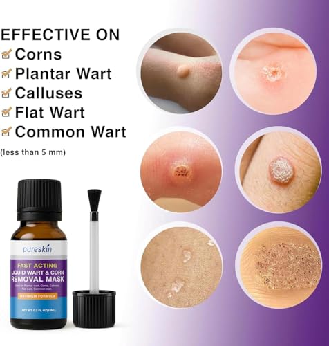 Image of PURESKIN Plantar Wart Corn Remover for Feet: 17% Salicylic Acid Wart Corn Removal Treatment for Corn, Plantar Wart, Common Wart & Flat Wart on Toes, Fingers, feet and Hand - 0.5 Fl Oz (Pack of 1)