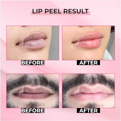 DR. SAKHIYA'S Lip Peel Solution For Dark Lip | Heals & Hydrates Chapped Lips 10% Arginine & Lactic Acid with 2% Alpha Arbutin For Dark & Pigmented Lips (10ml - Pack Of 1)