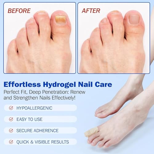 Fungal Nail Patch Treatment – Antifungal Toenail & Fingernail Solution | Kills Nail Fungus at Root | 10 Easy-to-Use Patches (H) - Image 6 thumbnail