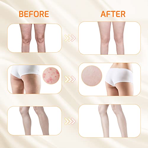 Cosmpro Butt Exfoliating Body Scrub, Kp Bump Eraser Body Scrub, Razor Bump & Ingrown Treatment For Bikini Area, For All Skin Type With Aha, Bha And Natural Ingredients, Butt Scrub Wash Prevents Acne #TOP1