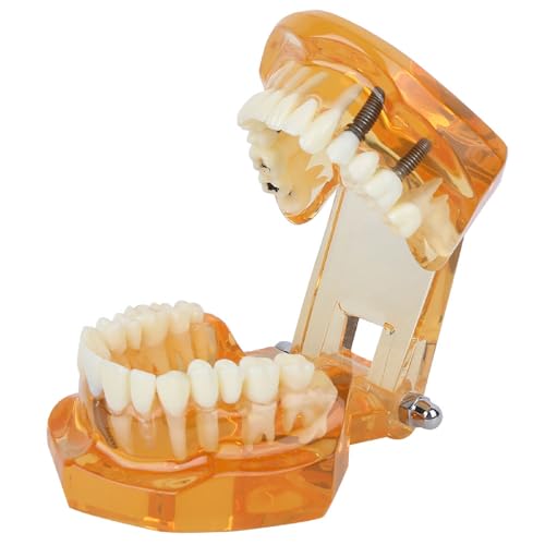 Natudeco Zahnmodell Dentalmodell Zahnkrankheits-Lehrmodell Dental Maxillary Overdenture Model Minderwertiges Präzisionsimplantat Demo with 4 Implantats for Zahnarztlaborklinik Zahnarztköpfe