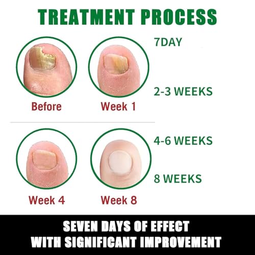 Ginger Nail Growth Strengthener Serum: Ginger-Infused Nail Repair Oil for Care, Natural Nail and Strengthener Solution