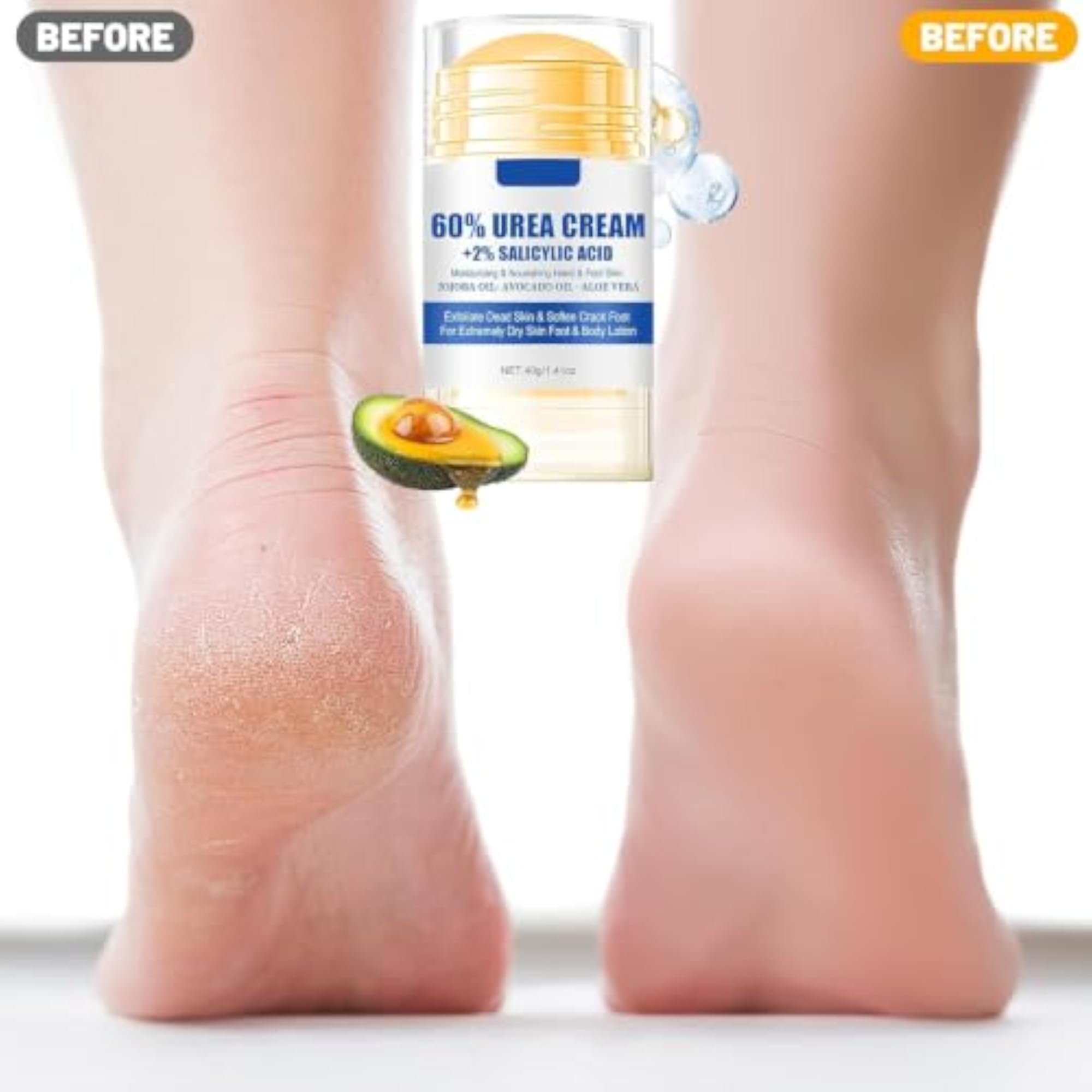 60% Urea Cream with 2% Salicylic Acid, Moisturizing Foot Cream