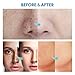 Razor Bump Stopper with Ingrown Hair Treatment: Razor Bumps Treatment for Men and Women, After Shave Solution for Ingrown Hairs and Razor Burns, Roll on Applicator- 3.38 Fl Oz