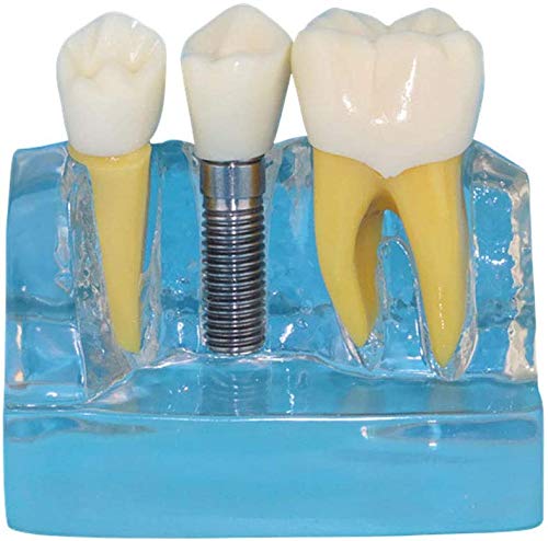 Modèle De La Dent Humaine, Modèle Dentaire Transparent Personnes Modèle Oral, Implant Dentaire Utilisé pour La Recherche dans Les Domaines De La Communication Ou L'Affichage Patients