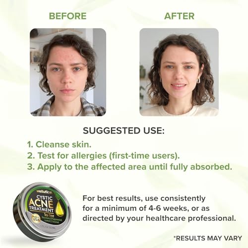 Cystic-Acne-Treatment-Cream-Natural-Pimple-and-Scar-Remover-with-Tea-Tree-Oil-Effective-Overnight-Face-Treatment-for-Acne-Spots-Pimples-and-Scars-1oz