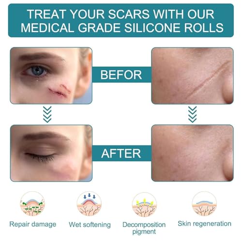 Image of Silicone Scar Removal Tape (1.5M Roll) Medical Grade Reusable Scar Reduction Sheets For Surgical, Handmade , BPA Free,C-Section, Acne, Burn & Keloid Scars Soft & Breathable Skin Tape EQUSUPRO (Silicone Scar Sheets)