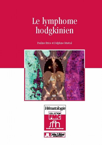  Le lymphome hodgkinien (FMC - Hématologie) livre En ligne
