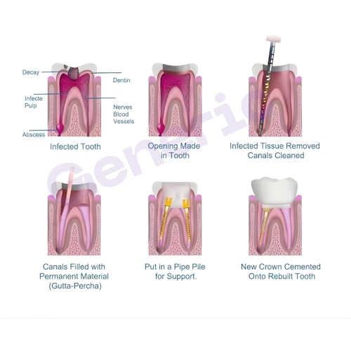 Image of Dental Titanium Steel Alloy Screw Post Root Canal Pin Conical Core Crown 120 Pcs Kit with 12 Sizes, 2 Keys & 2 Drills for Post Core Restoration