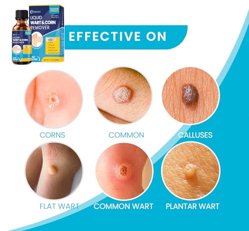 salicylic wart removal freeze away fast-acting wart removal maximum strength for men and women - plantar wart genital wart corns calluses 30 ml
