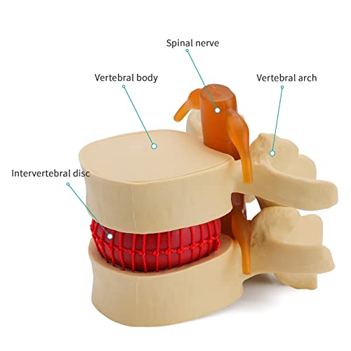 Image of Disc Herniation Model - Human Lumbar Disc Herniation Spine Model 1.5X Intervertebral Disc Model Anatomical Vertebrae Disc Model with Elastic Software