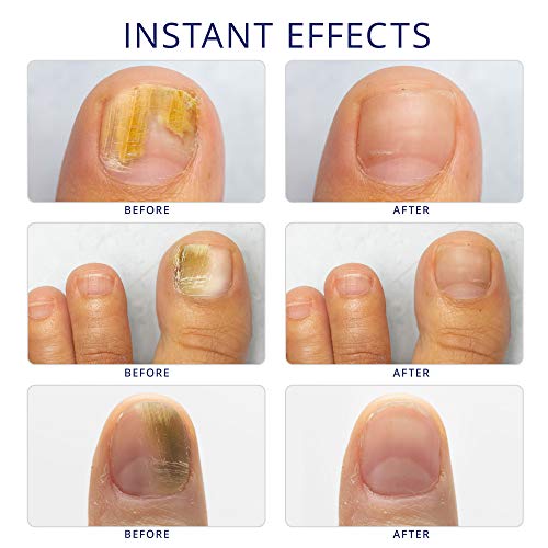 Nail Fungus Treatment for Toenail Extra Strength, Antifungal Solution
