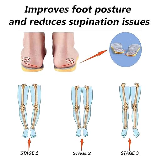 Goodern O Leg XO Leg Corrector Correction Insole,Breathable Orthotic PU Shoe Inserts for Men and Women,Supination Insoles for Over Supination High Arch Support Foot Alignment Relief Foot Fatigue-S